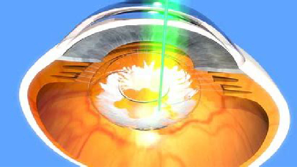 TRATTAMENTI LASER